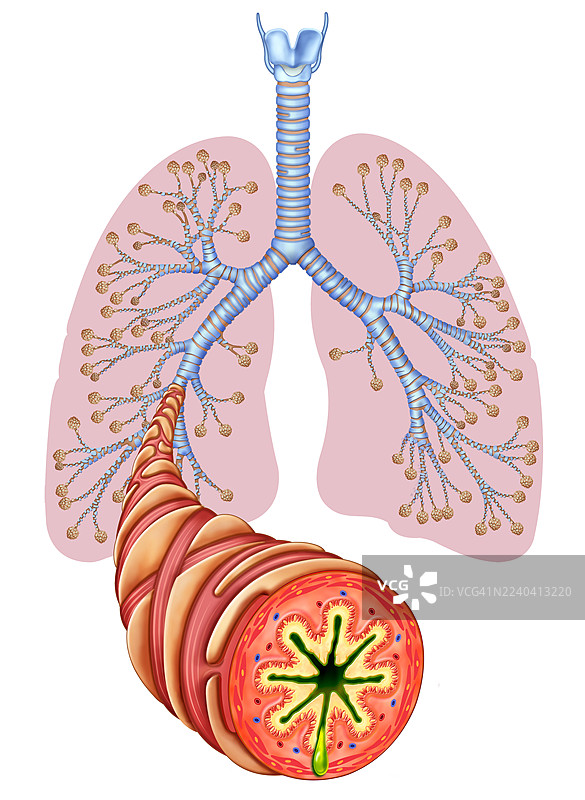 哮喘性支气管炎症，插画图片素材