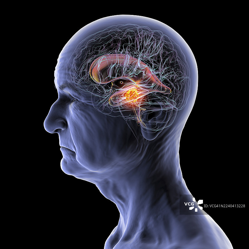 脑肿瘤导致脑积水，插画图片素材