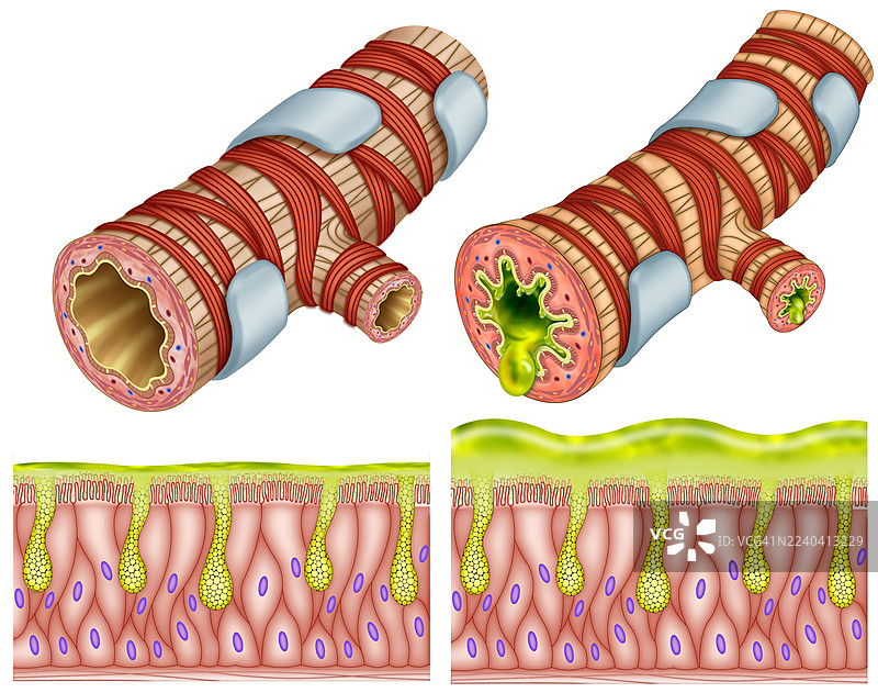 支气管上皮黏膜，插画图片素材