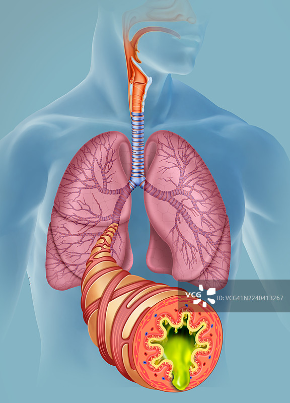 急性支气管炎引起的炎症气道，插画图片素材
