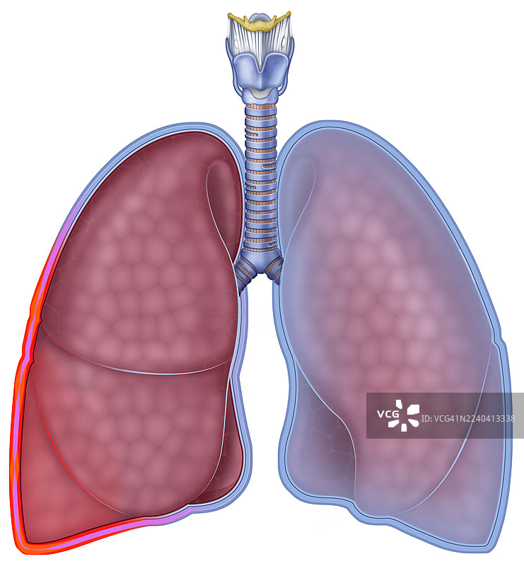 胸膜炎的肺部，插画图片素材