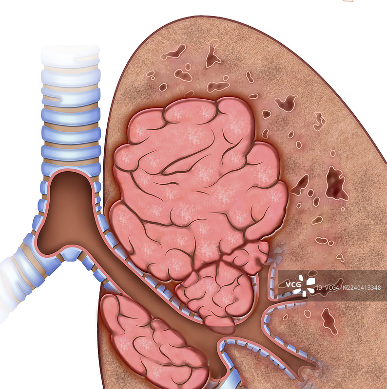 肺癌，插画图片素材