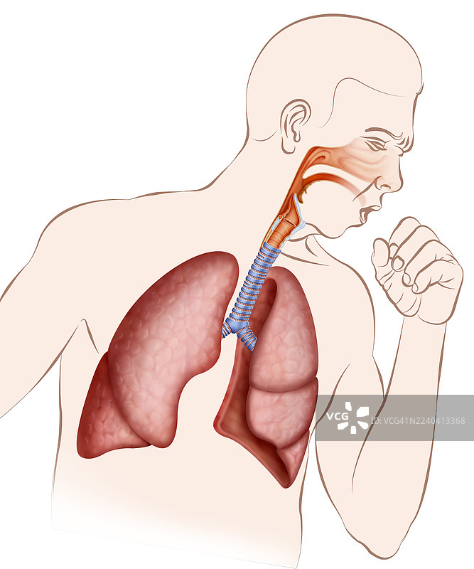 卡通插画：因支气管刺激而咳嗽的人图片素材
