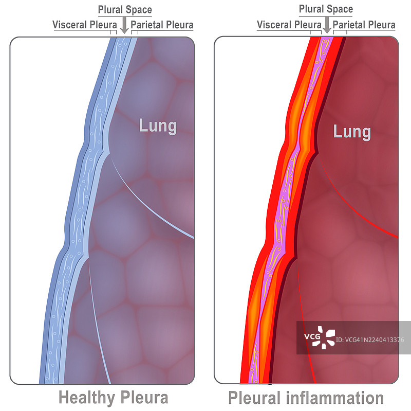 肺胸膜炎，插画图片素材