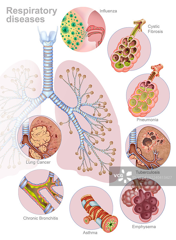 呼吸系统疾病，插画图片素材