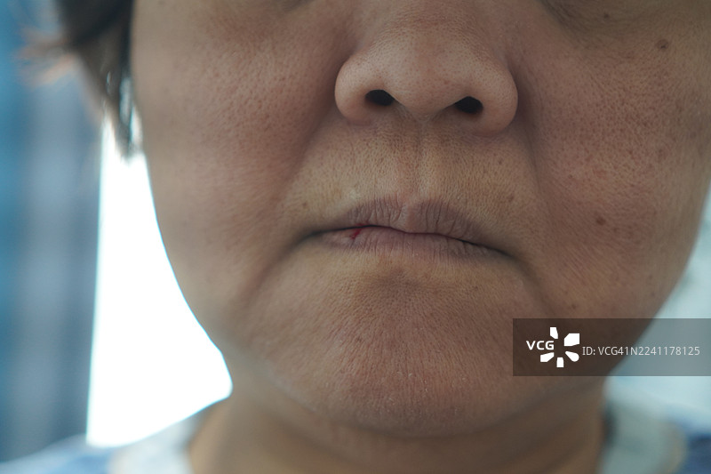 嘴唇疱疹的女性图片素材