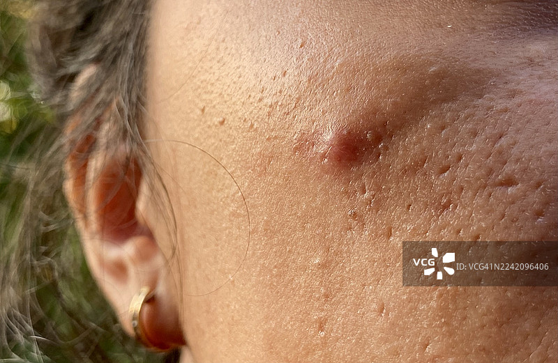 特写镜头，一名女性脸颊上的痤疮图片素材