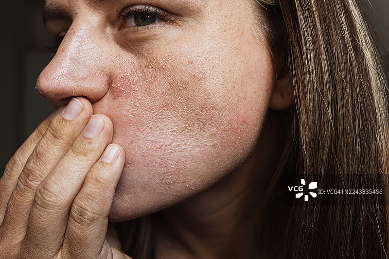 特写镜头，一名女子用干燥脱皮的皮肤触摸脸部，凸显护肤问题图片素材