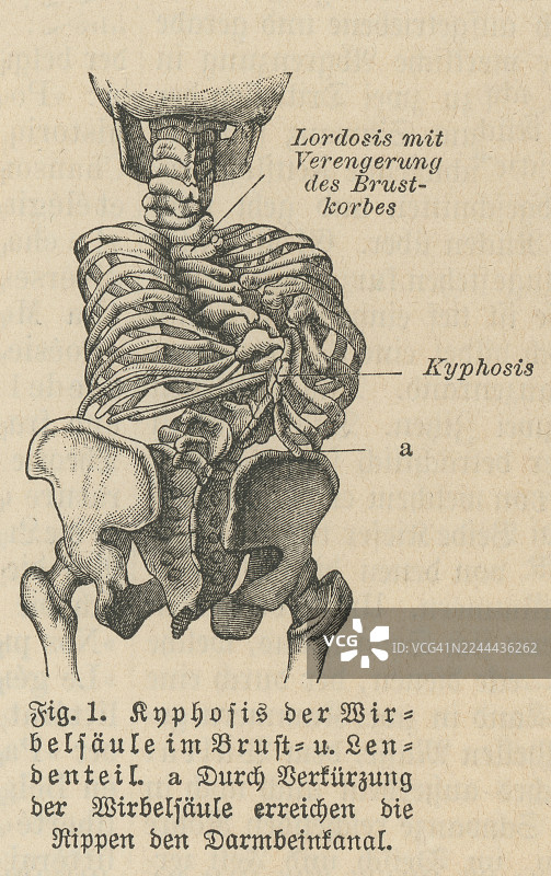 脊柱后凸的旧蚀刻插图，指上部脊柱过度向外弯曲，导致外观圆背或“驼背”（脊柱在胸部和骶骨区域出现异常过度的凸状弯曲）。图片素材