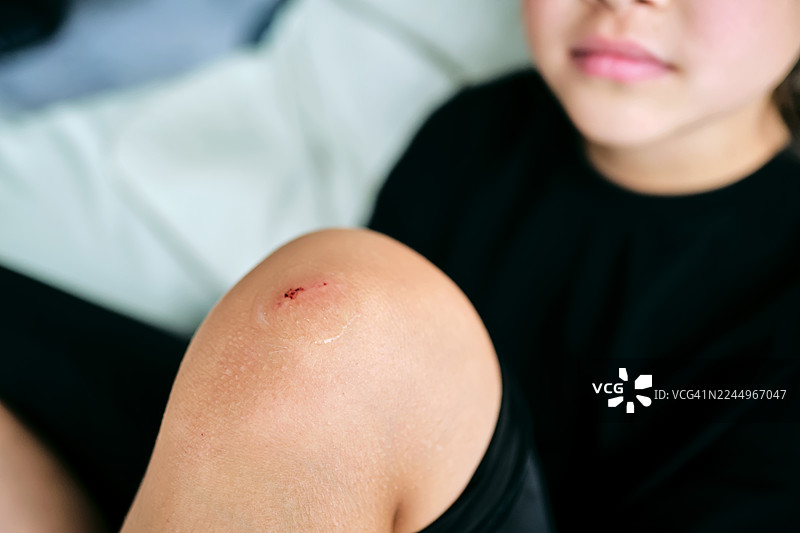 孩子膝盖擦伤，因事故感到疼痛图片素材