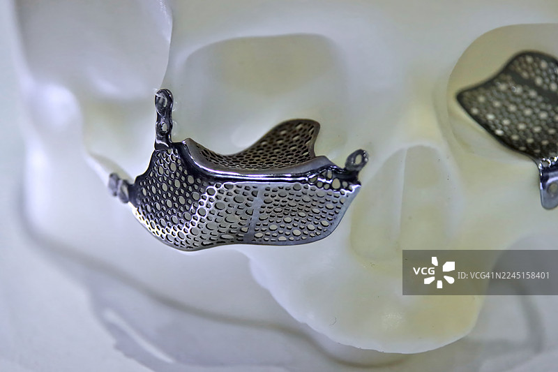 用于重建手术规划的定制化3D打印多孔钛网手术板，安装在白色聚合物颅骨模型上，特写镜头。图片素材