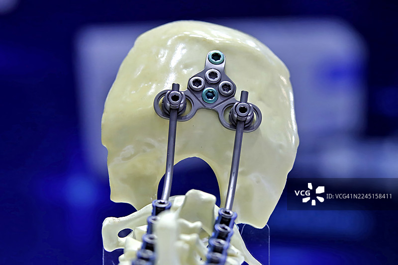 多孔骨板和连接杆牢固地固定在骨盆模型上，说明用于复杂脊柱畸形矫正的手术技术图片素材