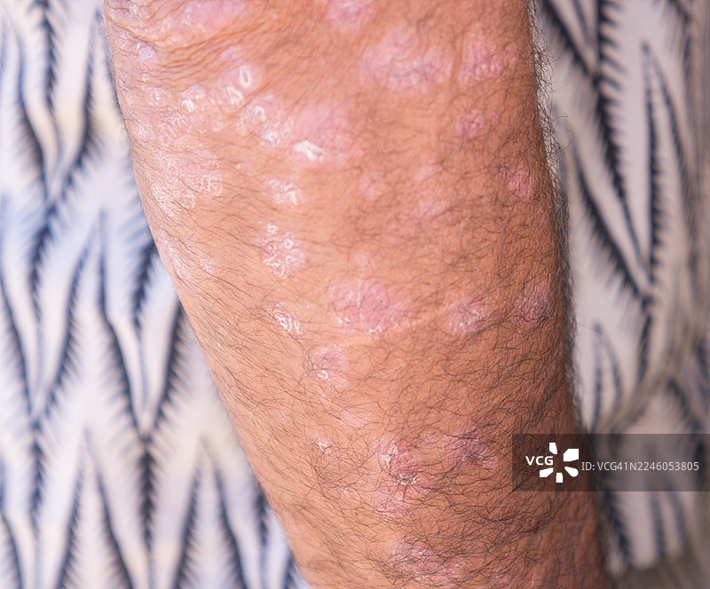 一只手臂上的银屑病。图片素材