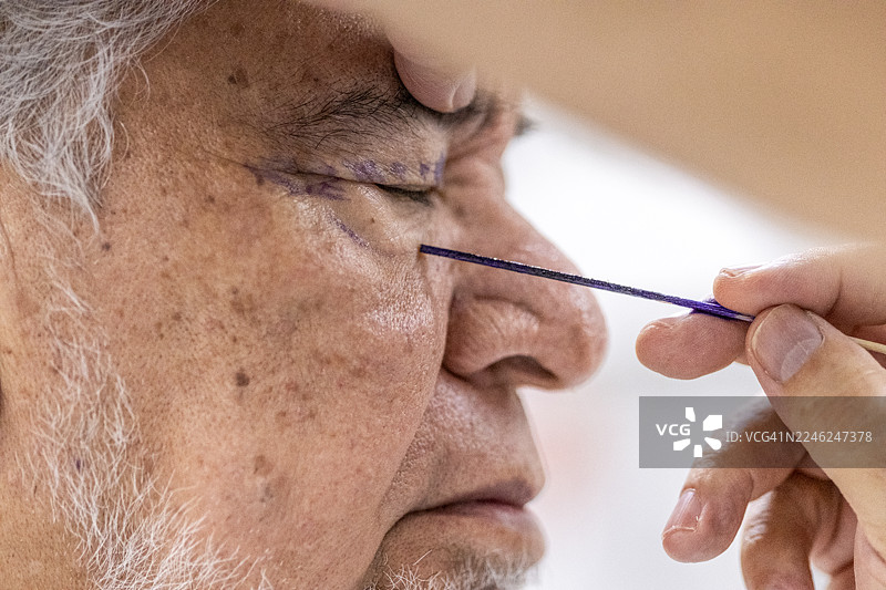 上睑成形术展示手术开始前的过程，包括在进行切口前的术前标记。图片素材