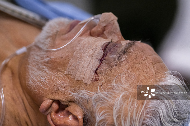 上睑成形术 面部年轻化的眼睑美容手术。该手术用于矫正眼睑下垂、去除多余皮肤（皮肤松弛）和眼袋，从而达到年轻化的效果。图片素材