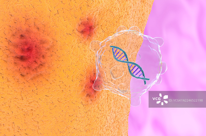 类风湿关节炎基因疗法，概念插画图片素材