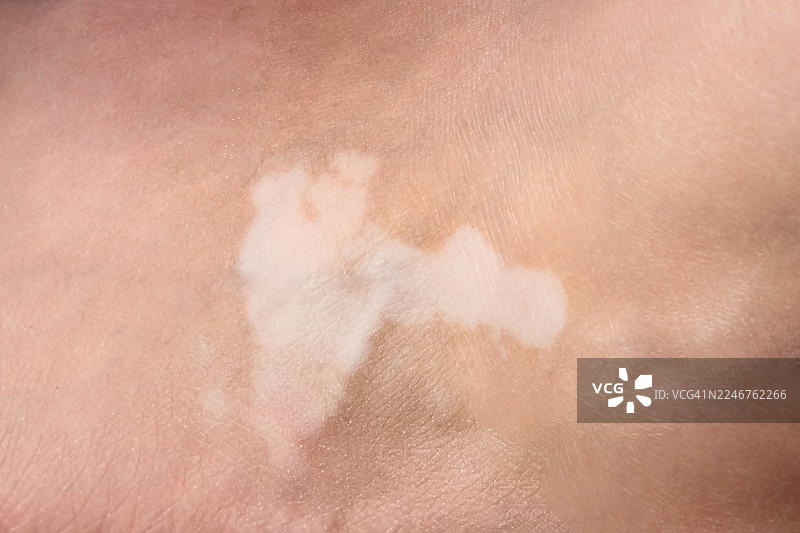 特写全景镜头，拍摄人类白癜风皮肤，展示脱色素现象图片素材