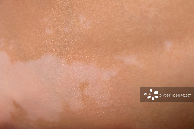 特写镜头下人类皮肤上的白癜风斑块图片素材