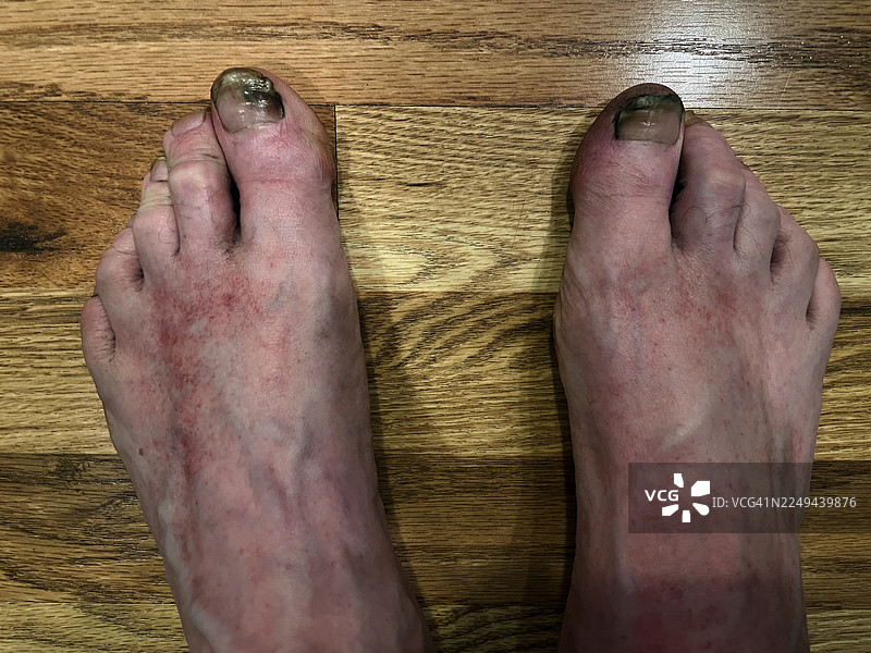 黑趾真菌感染图片素材