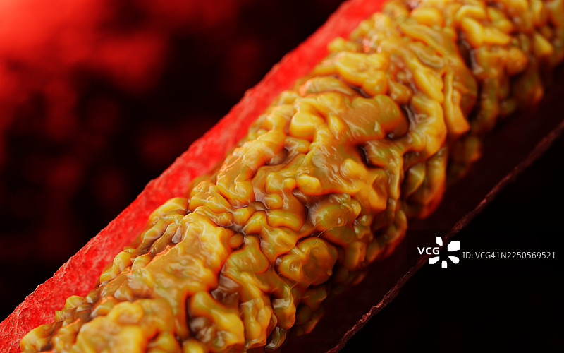 动脉粥样硬化疾病。血管中的胆固醇图片素材