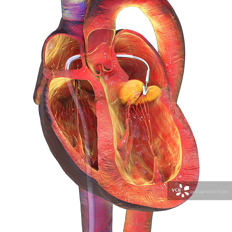 经导管心脏缘对缘修复术，插画图片素材