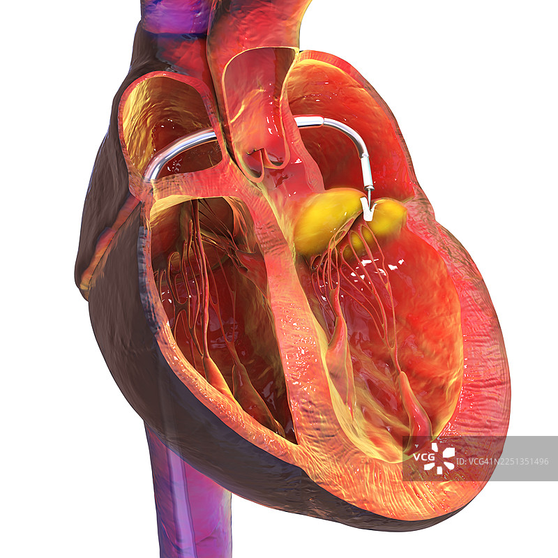 经导管心脏边缘修复术，插画图片素材