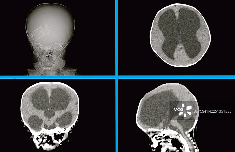 脑积水，CT扫描图片素材