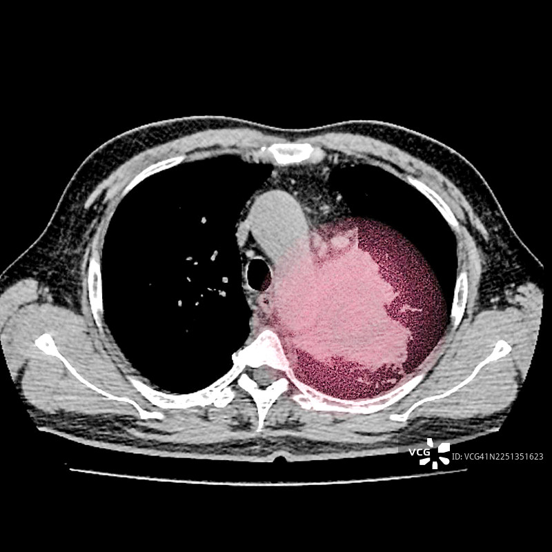 肺癌，CT扫描图片素材