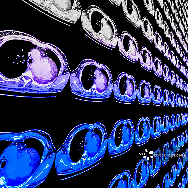 肺癌，CT扫描图片素材