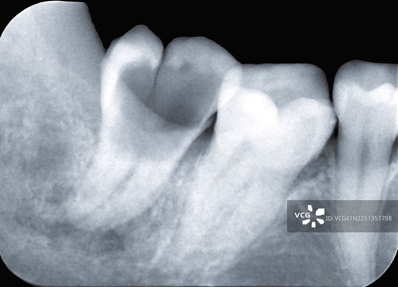 阻生智齿和龋齿，根尖X光片图片素材