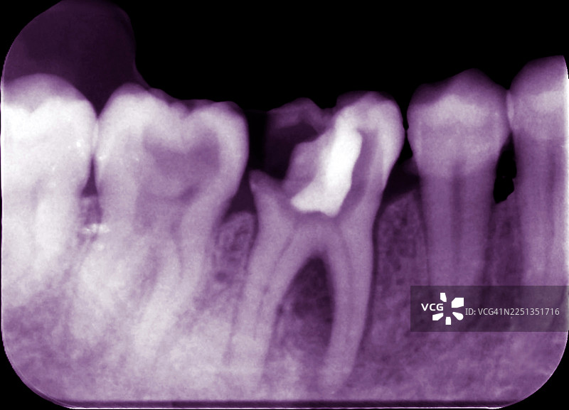 阻生智齿与龋齿，根尖X光片图片素材