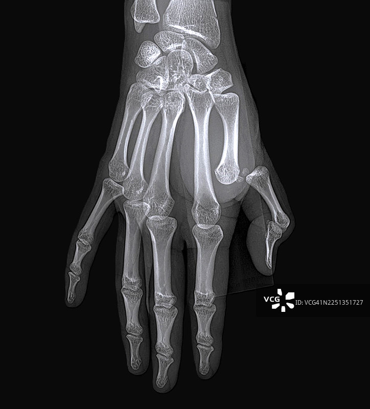 骨性关节炎，X光片图片素材