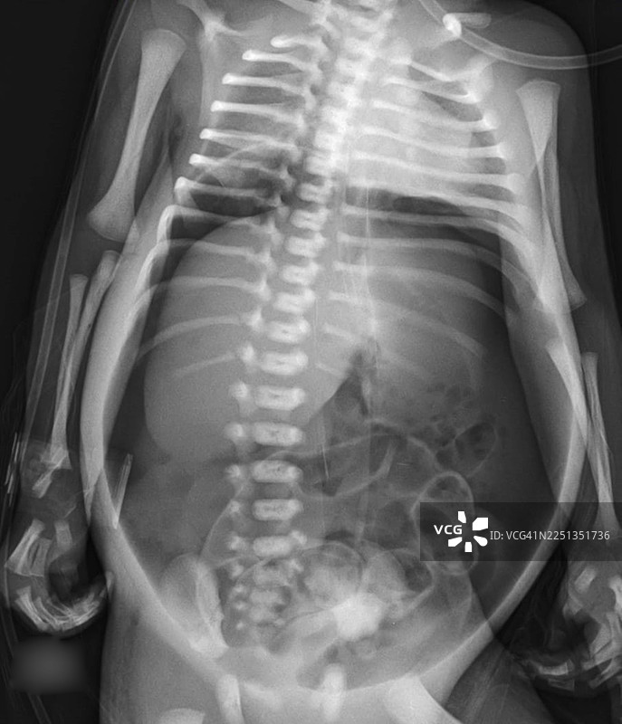 气腹，X光片图片素材
