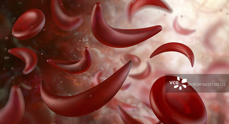 镰状细胞贫血症，插画图片素材