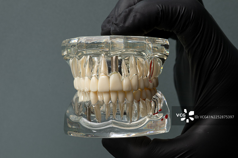 戴着黑色手套的手握着带有牙齿和植入体的牙颌模型，用于牙科教育和医疗保健图片素材