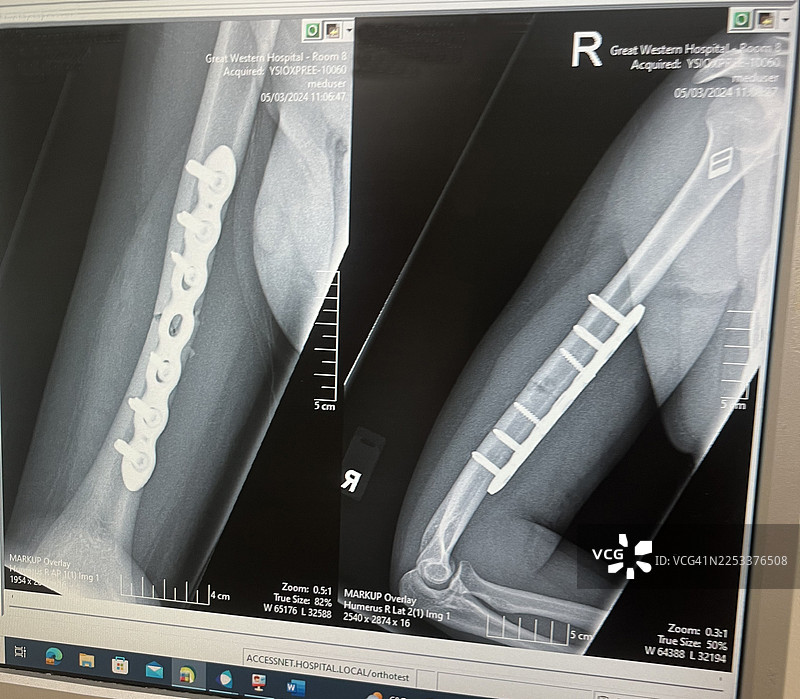 肱骨骨折图片素材