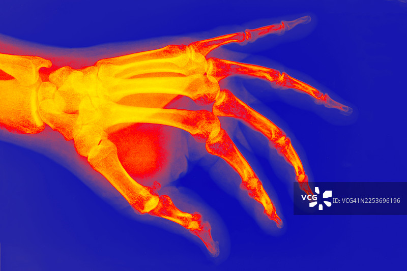 红外热成像下的人手X光片图片素材