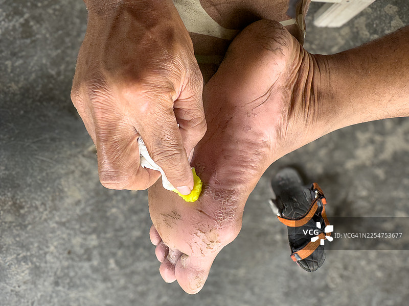 用棉花处理脚气，高角度拍摄图片素材