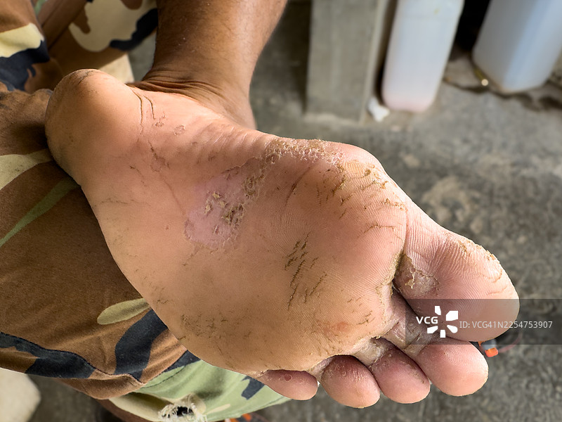 脚底患有足癣的特写镜头图片素材