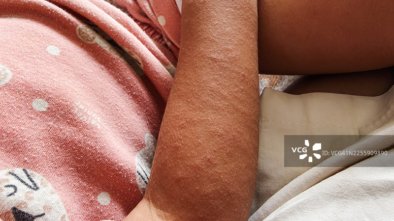 儿童麻疹图片素材