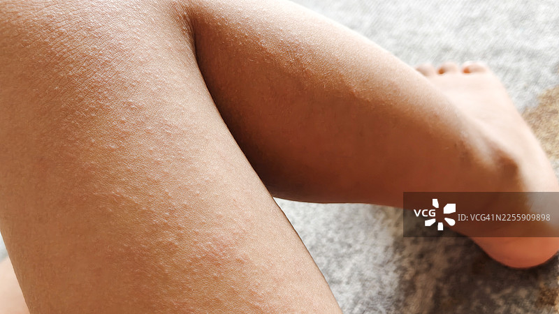 儿童麻疹图片素材