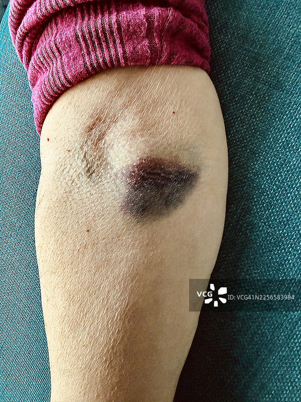 抽血后女性手臂上的淤青图片素材