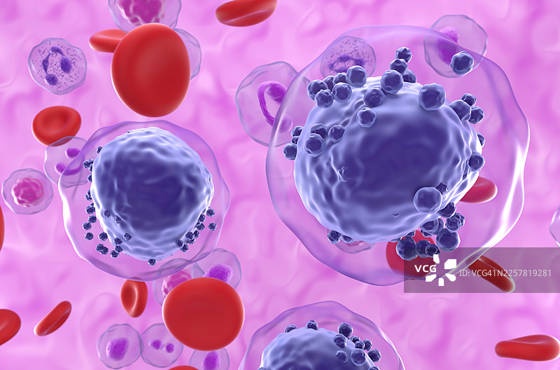 急性淋巴细胞白血病，插画图片素材