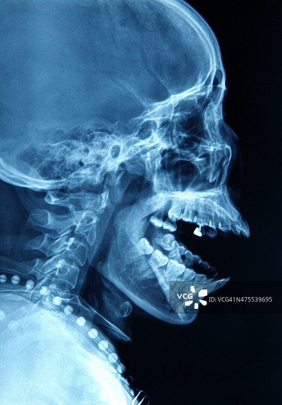 头部X光片图像图片素材