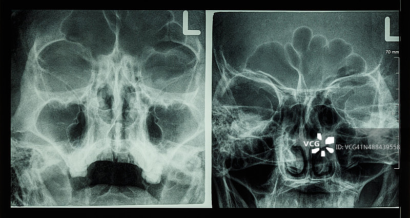鼻窦X光片图片素材