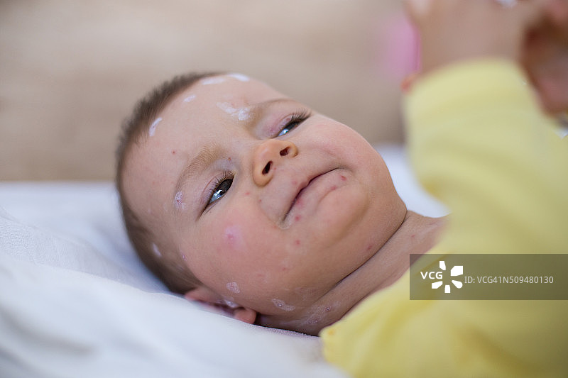 患有水痘的女婴图片素材