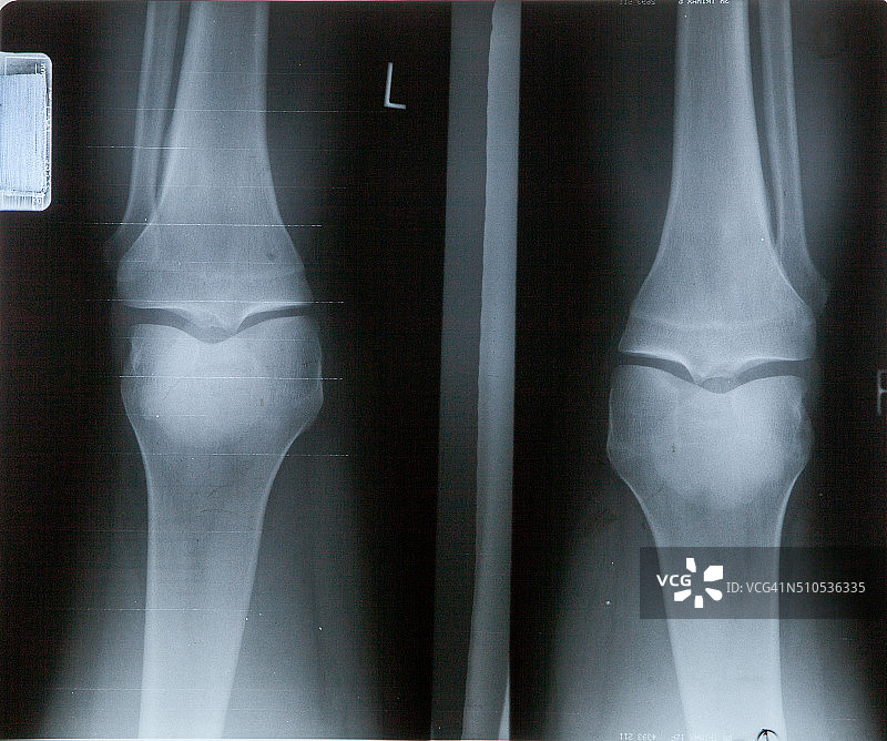 脚踝、足部和膝关节疼痛的人体X光MRI胶片图片素材