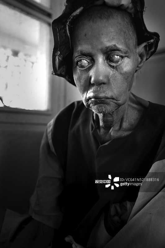 麻风病图片素材