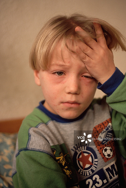 患水痘的图努伊·弗兰肯图片素材