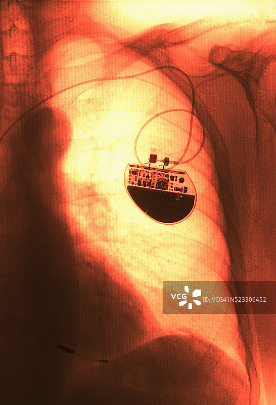 显示起搏器的X光片图片素材